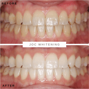 30代女性 ホワイトニング症例