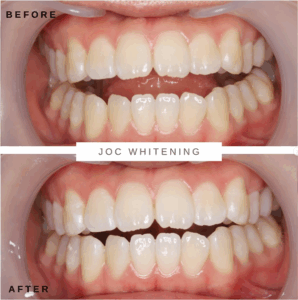 20代女性 ホワイトニング症例