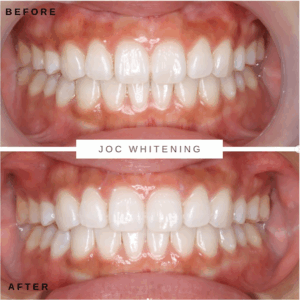 30代女性 ホワイトニング症例