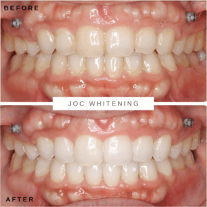 30代女性 ホワイトニング症例