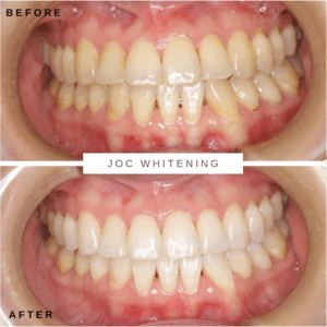 20代女性 ホワイトニング症例